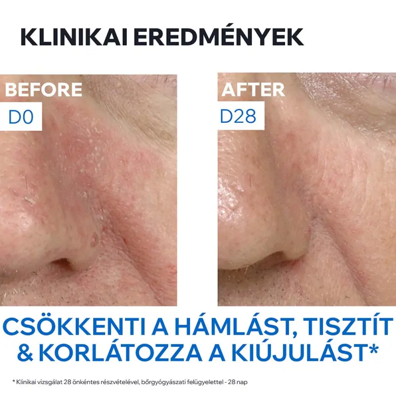Rutin sebhorreas dermatitisz kiegészítő ápolására