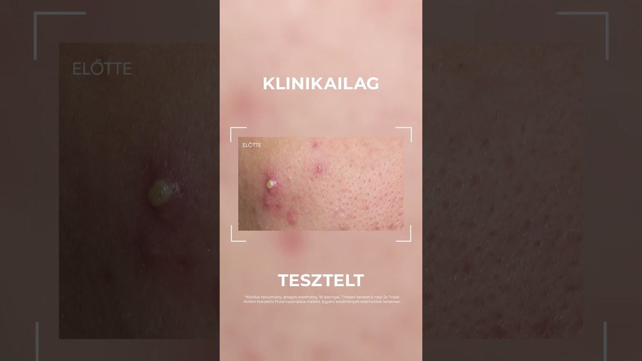 DermoPure Clinical Triple Action - Korrektív Fluid: Magabiztosan az akne ellen